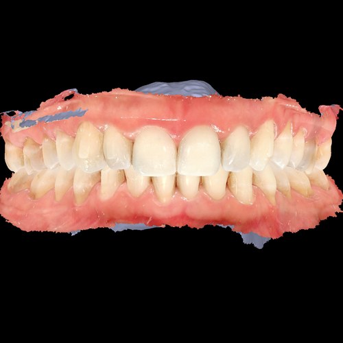 Escaneo intraoral 3D